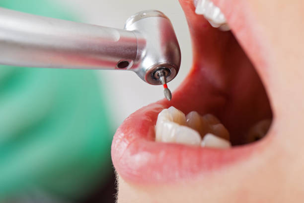 Best Lost Filling or Crown Replacement in Dawson Springs, KY